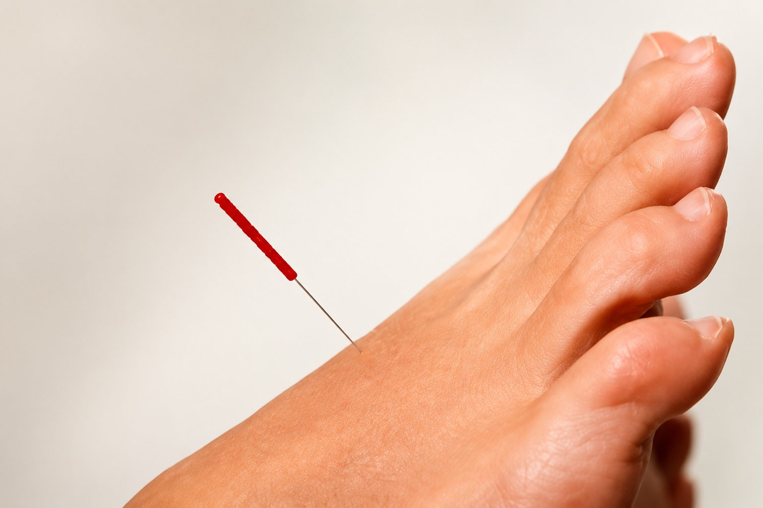 A single acupuncture needle placed on the top of a foot